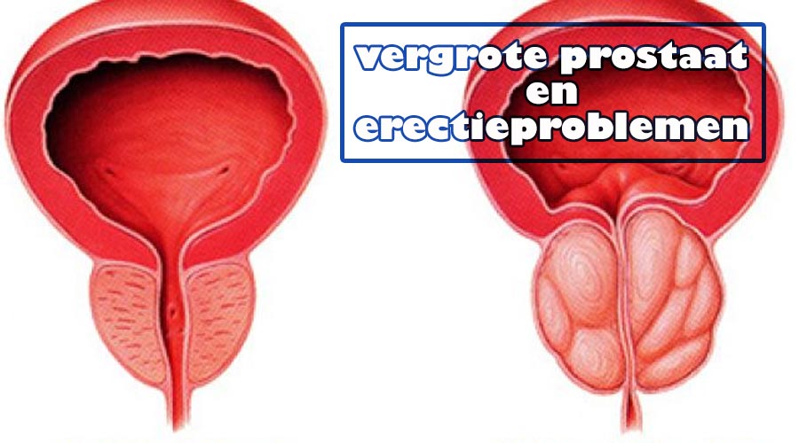 vergrote prostaat en erectieproblemen